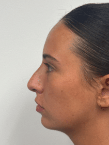 Before Image: Rhinoplasty