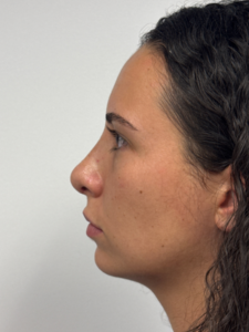 After Image: Rhinoplasty