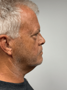 Before Image: Neck Lift