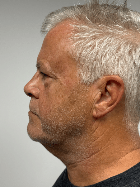 Before Image: Neck Lift - left-side