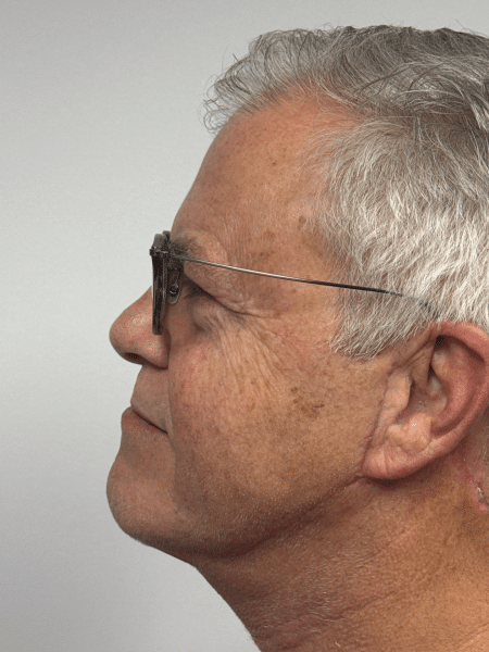 After Image: Neck Lift - left-side