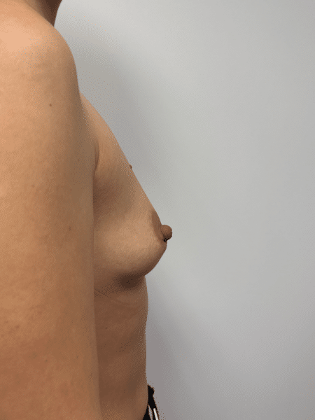 Before Image: Breast Augmentation - right-side