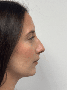 Before Image: Rhinoplasty
