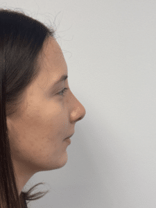 After Image: Rhinoplasty