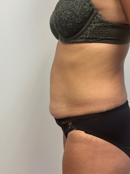Before Image: Abdominoplasty - left-side