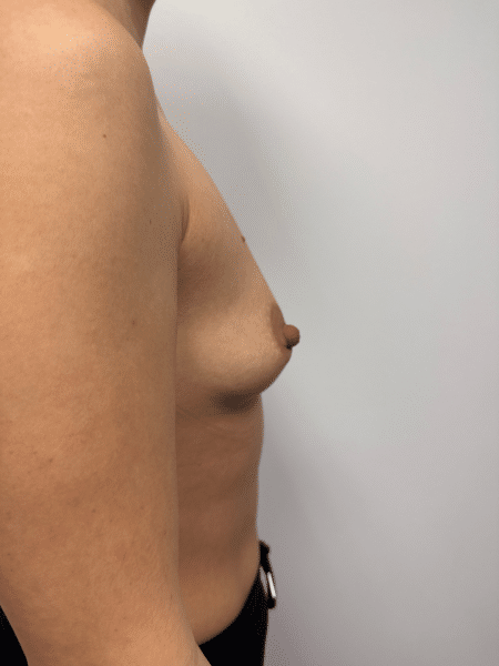 Before Image: Breast Augmentation - right-side