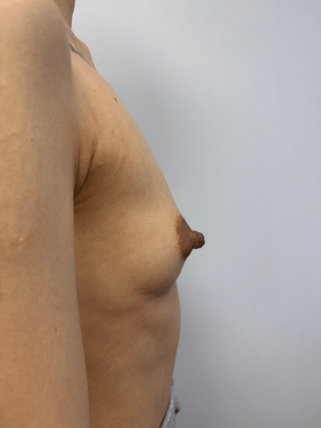 Before Image: Breast Augmentation - right-side