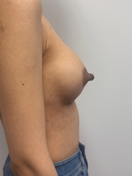 After Image: Breast Augmentation - right-side