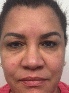 Before Image: Blepharoplasty