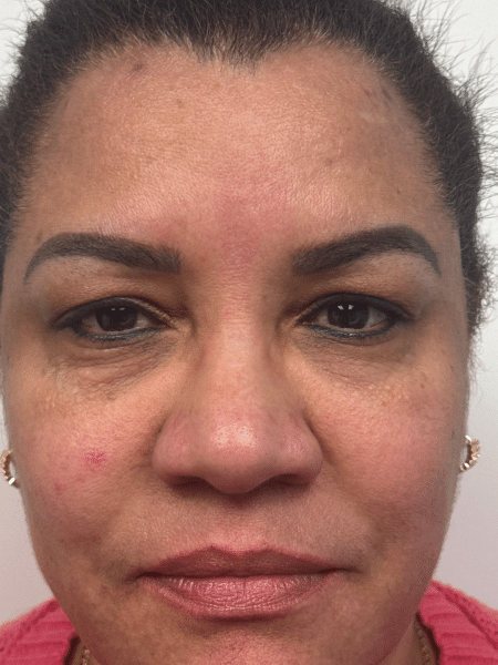 Before Image: Blepharoplasty - front