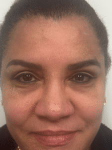 After Image: Blepharoplasty