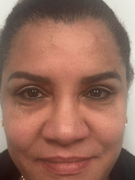 After Image: Blepharoplasty - front