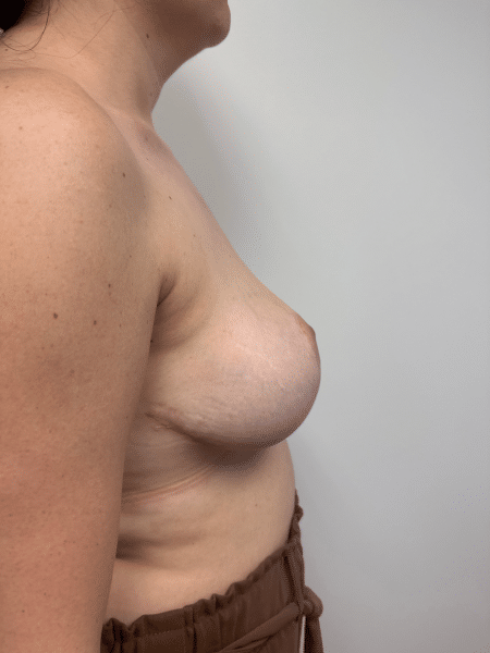 After Image: Breast Reduction -