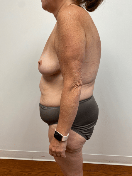 Before Image: Mommy Makeover -