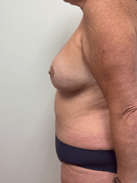 After Image: Mommy Makeover -