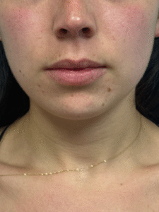 Before Image: Juvederm