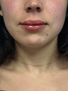 After Image: Juvederm