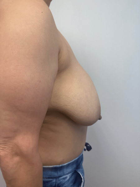 Before Image: Breast Reduction - right-side