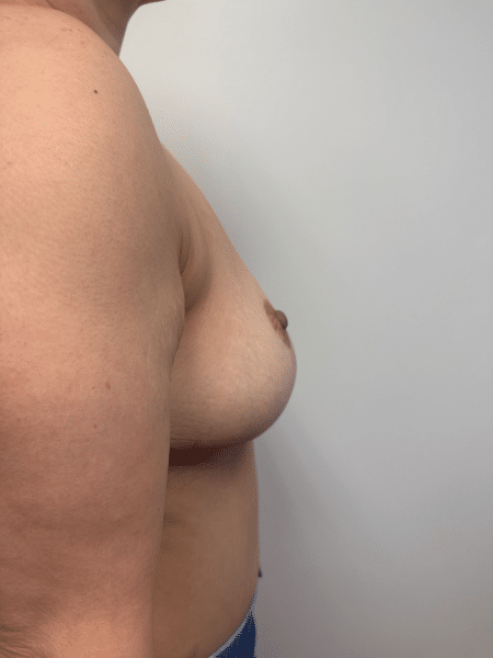 After Image: Breast Reduction - right-side