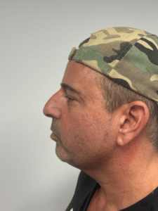 Before Image: Rhinoplasty