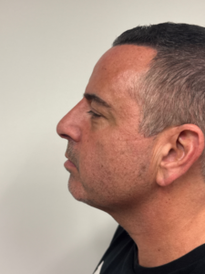 After Image: Rhinoplasty