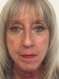 After Image: Blepharoplasty
