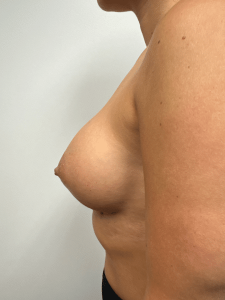 After Image: Breast Augmentation -
