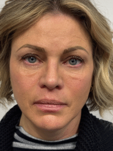 Before Image: Blepharoplasty