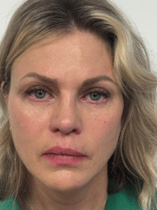After Image: Blepharoplasty