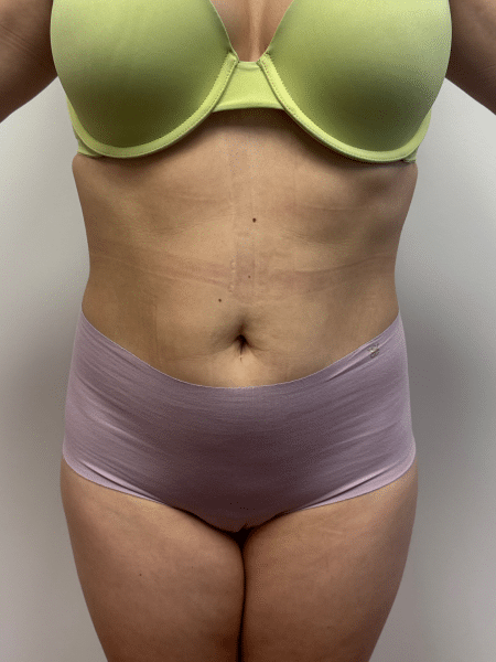 After Image: Liposuction - front