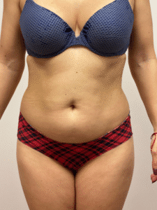 Before Image: Liposuction