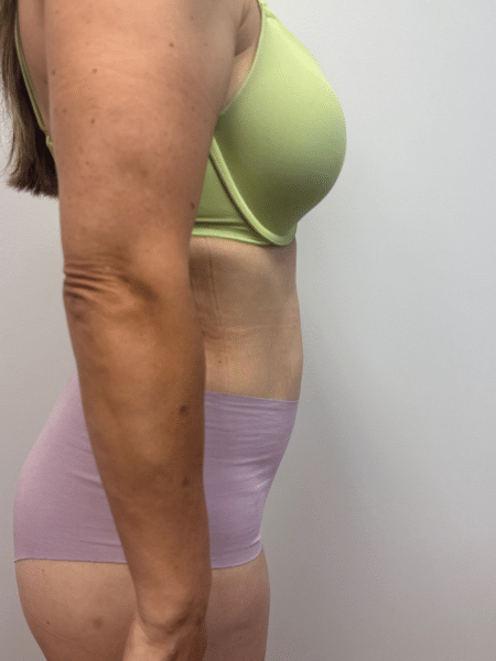 After Image: Liposuction - right-side