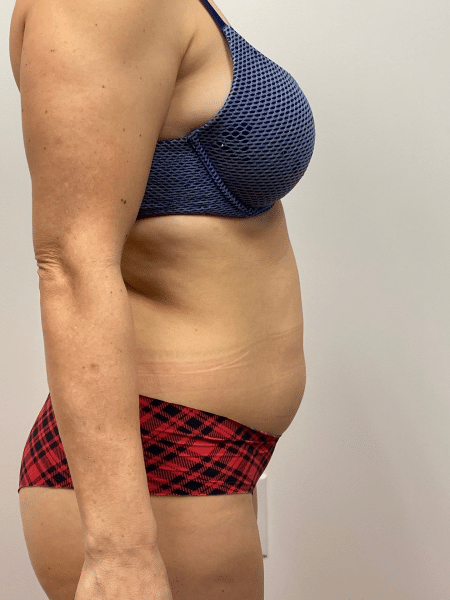 Before Image: Liposuction - right-side