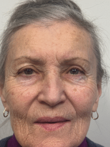 Before Image: Blepharoplasty