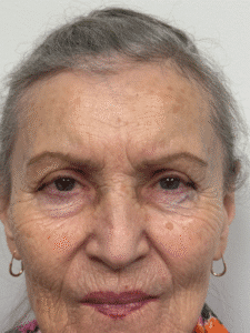 After Image: Blepharoplasty
