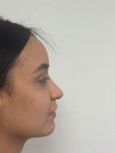 After Image: Rhinoplasty