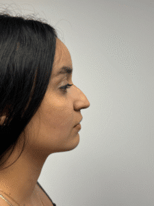 Before Image: Rhinoplasty