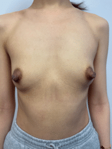 Before Image: Breast Augmentation