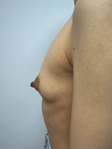Before Image: Breast Augmentation - left-side