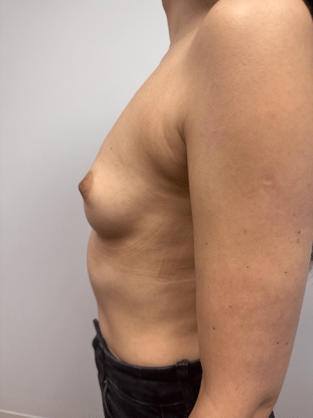Before Image: Breast Augmentation - left-side