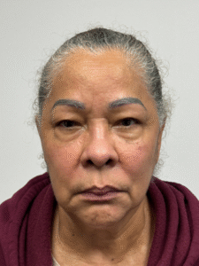 Before Image: Blepharoplasty