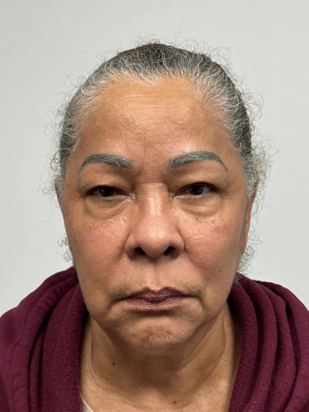 Before Image: Blepharoplasty - front