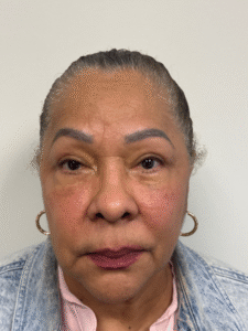 After Image: Blepharoplasty