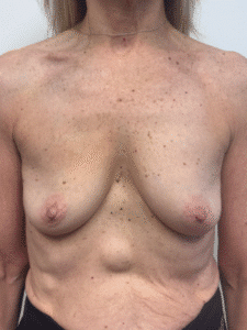 Before Image: Breast Augmentation