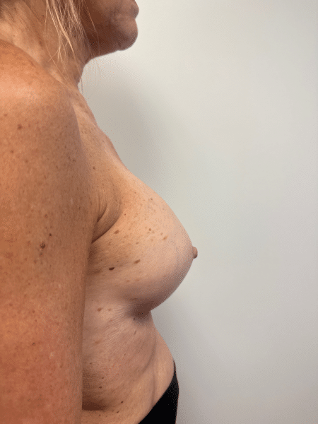 After Image: Breast Augmentation - right-side