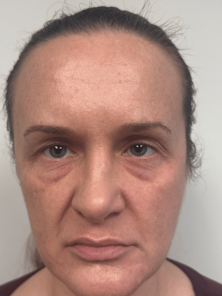 Before Image: Blepharoplasty - front