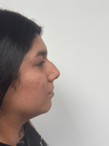 Before Image: Rhinoplasty
