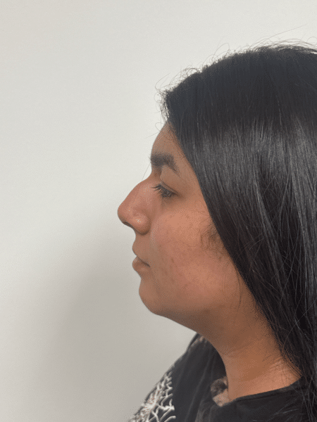 Before Image: Rhinoplasty - front