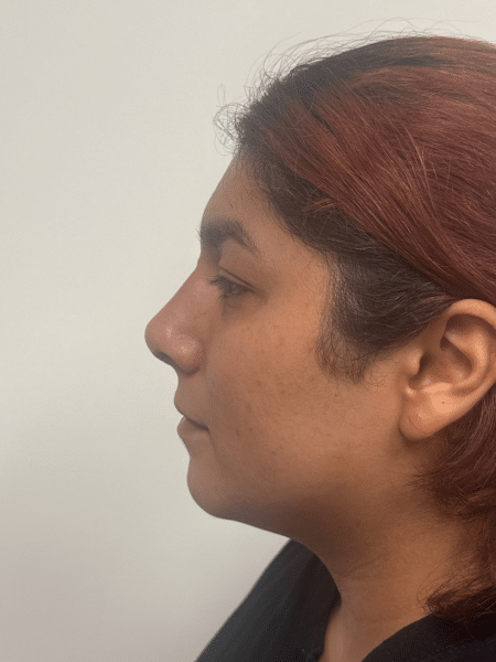 After Image: Rhinoplasty - front