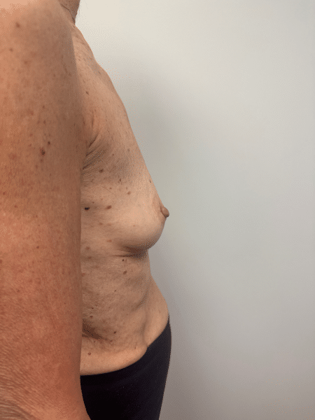 Before Image: Breast Augmentation - right-side